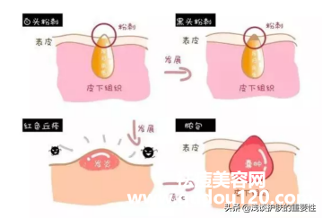封闭性粉刺用什么药膏最有效（去闭口粉刺最有效的方法）
