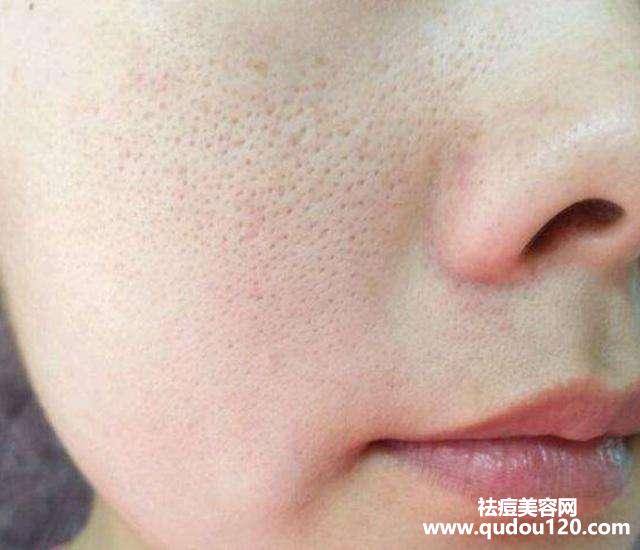 黑头粉刺毛孔粗大怎么去除最有效（黑头粉刺毛孔粗大用什么护肤品）