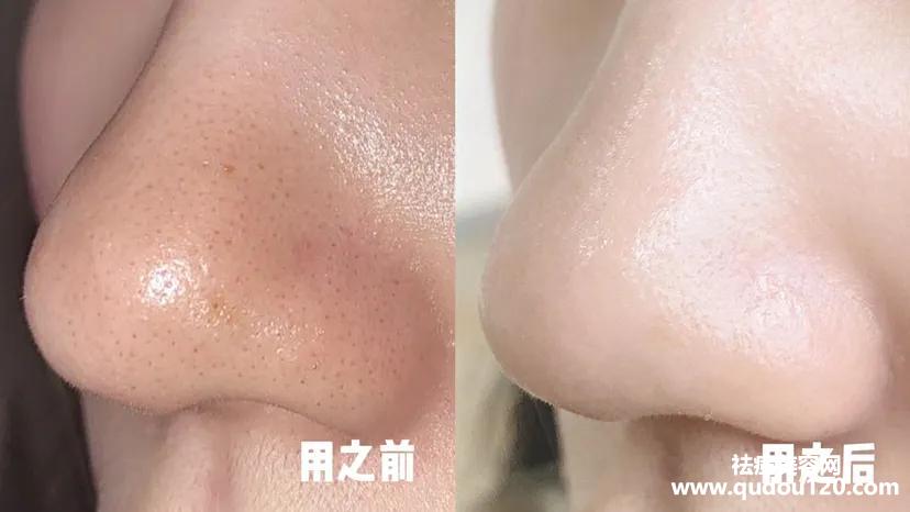 黑头粉刺怎么样才能彻底根除（如何快速消除黑头粉刺）