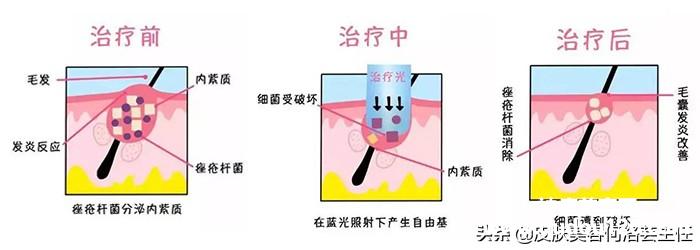红蓝光治痘效果怎么样（长痘照红蓝光好不好）