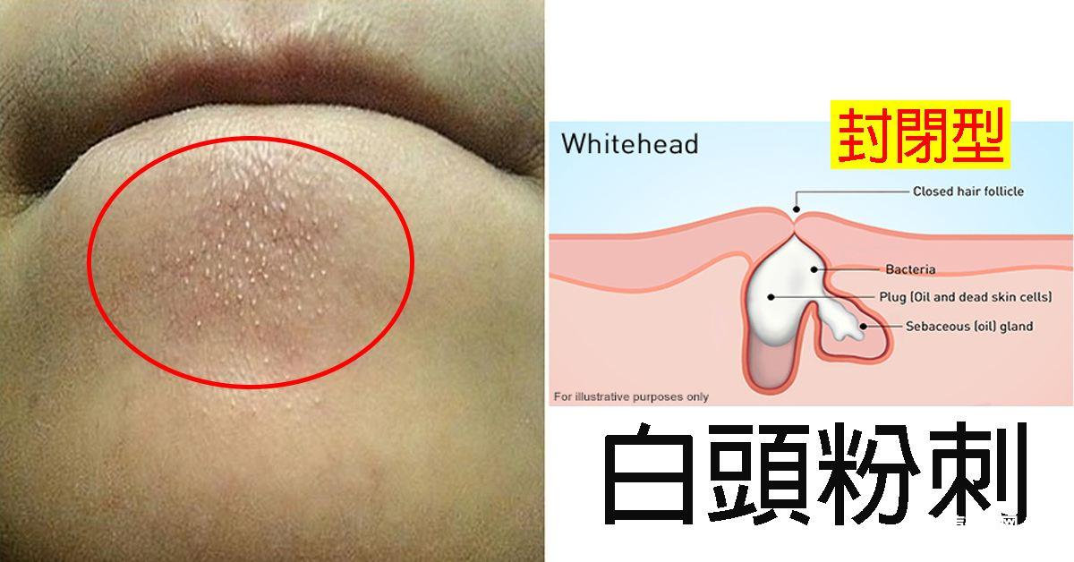 下巴长粉刺是什么原因引起的（下巴好多小米粒带白头）