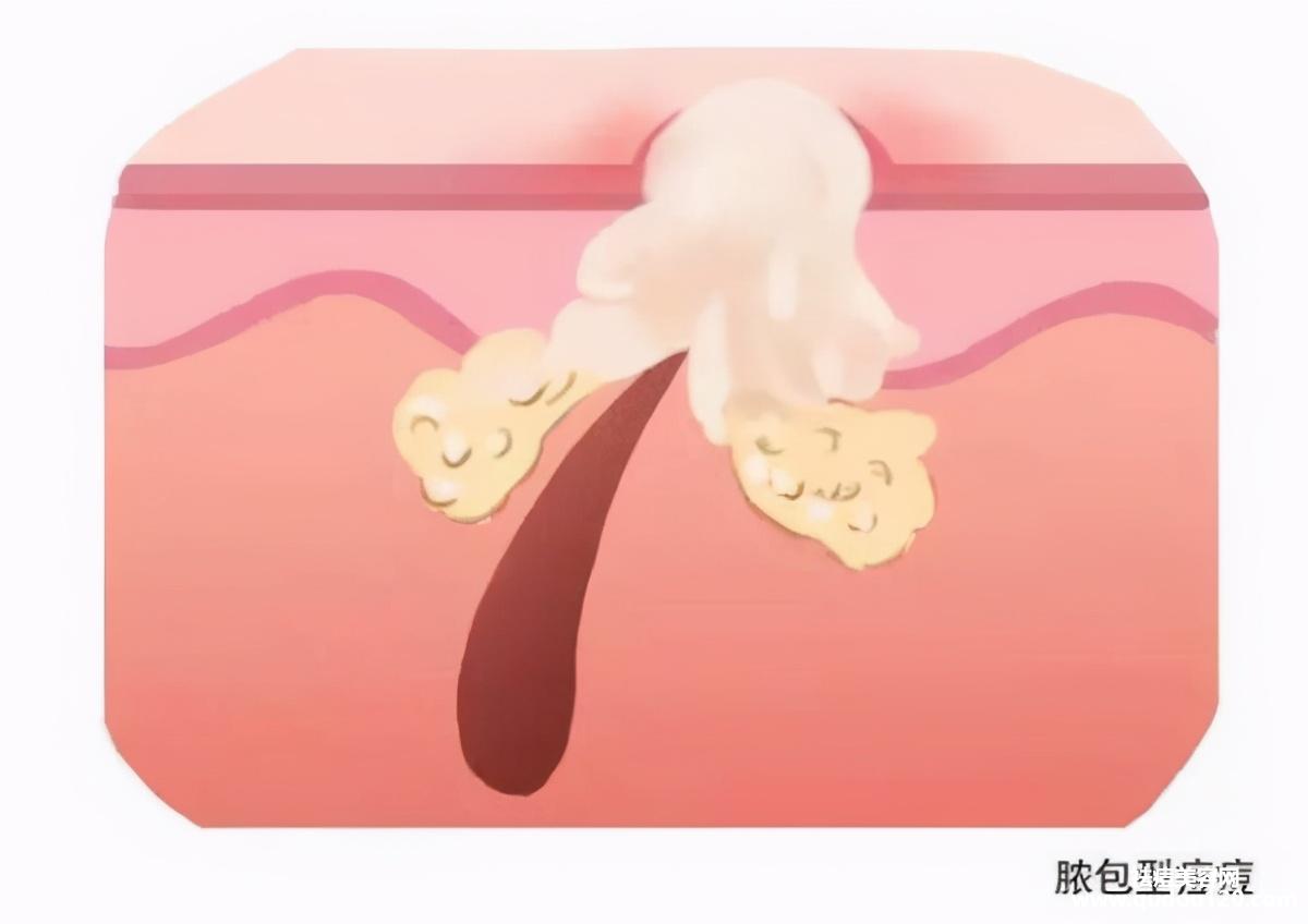 脓包型痤疮怎么治疗最彻底（严重脓包型痤疮怎么治疗）
