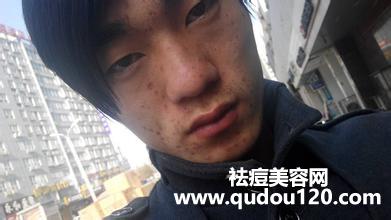 面部痤疮毛囊炎该怎么治疗（面部毛囊炎怎么解决）