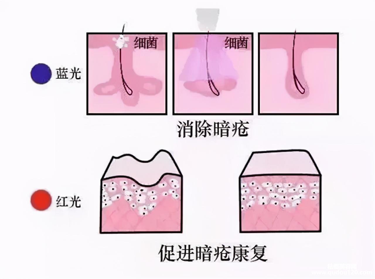 红蓝激光祛痘效果怎么样（痘痘严重红蓝光做几次才有效果）