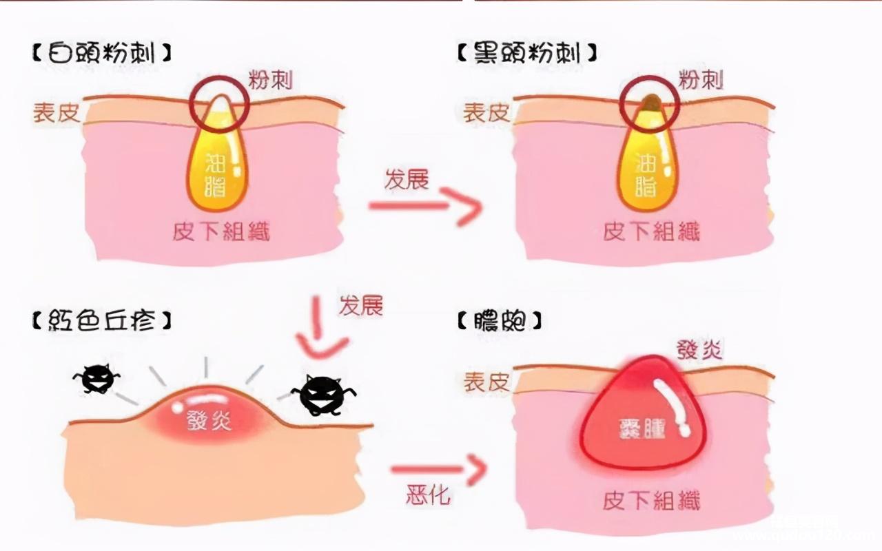 怎么去黑头和毛孔粗大（收缩毛孔去黑头最佳方法）