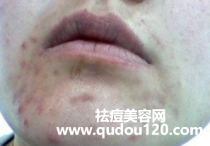 面部痤疮用什么药膏最好（痤疮外涂什么药膏比较好）