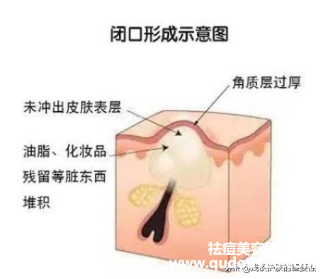 封闭性粉刺用什么药膏最有效（去闭口粉刺最有效的方法）