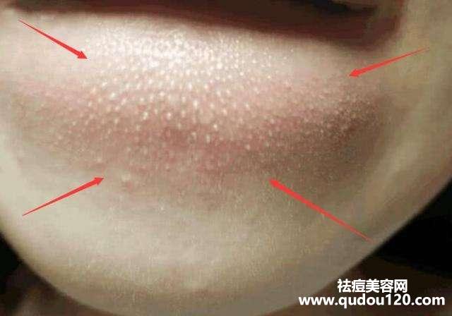 下巴长粉刺是什么原因引起的（下巴好多小米粒带白头）