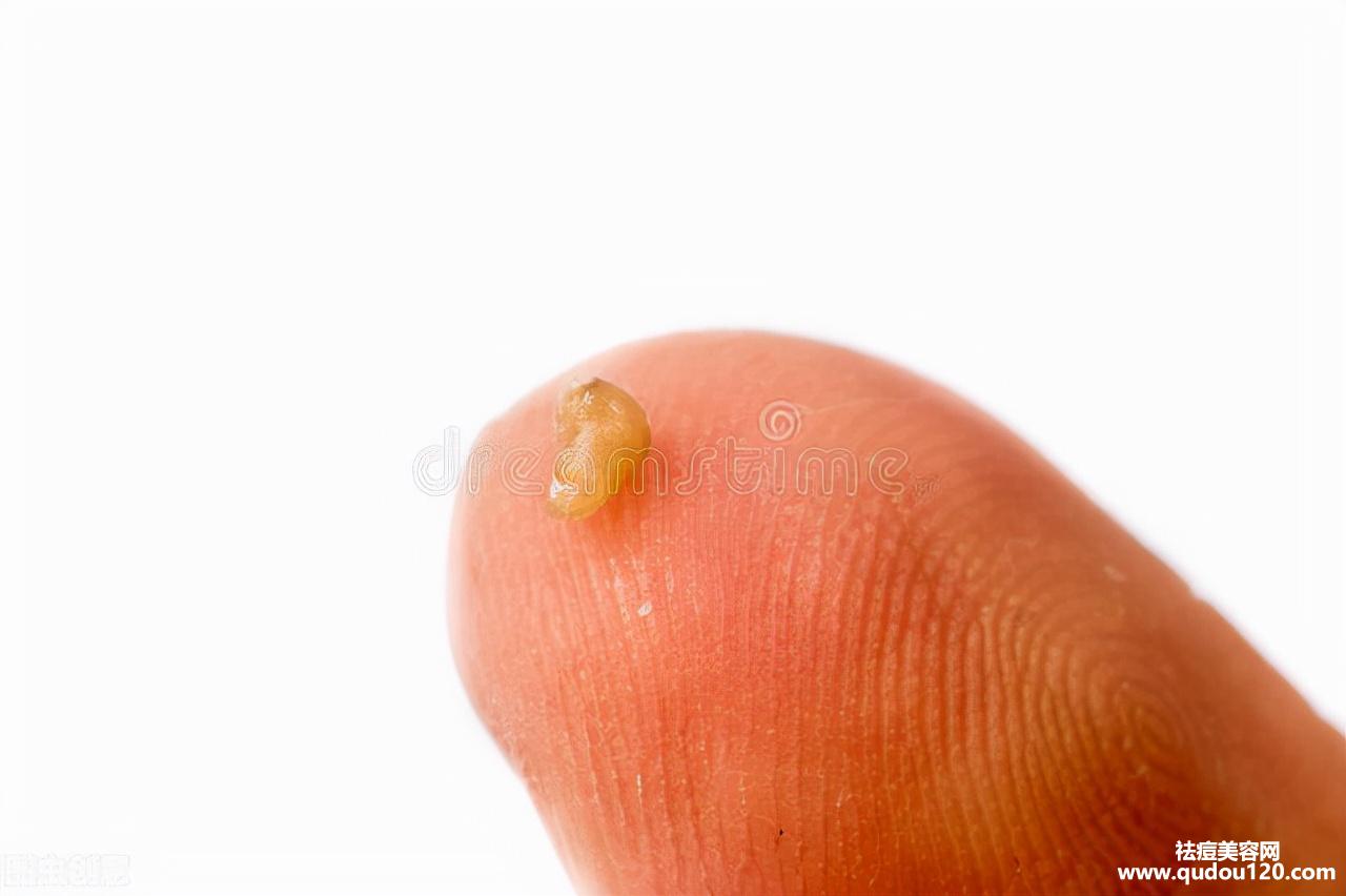 如何去黑头最快最有效（怎样才能让黑头永远消失）