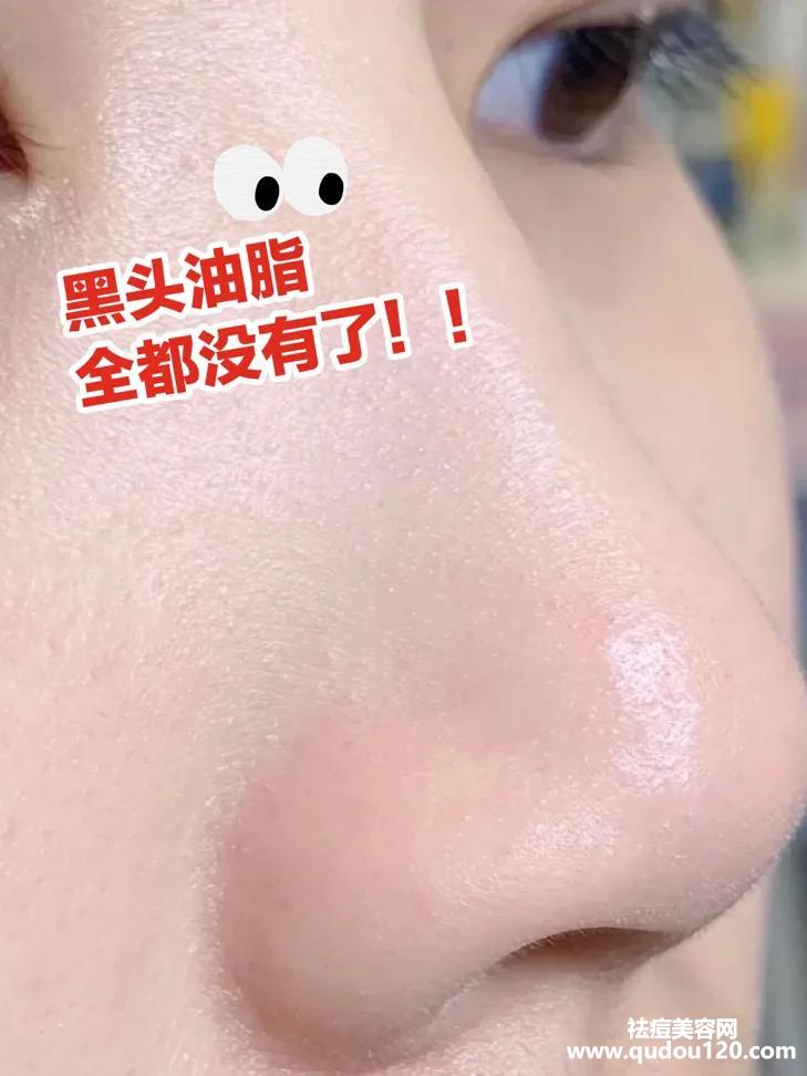 黑头粉刺怎么样才能彻底根除（如何快速消除黑头粉刺）