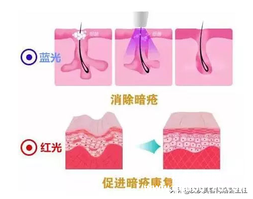 红蓝光治痘效果怎么样（长痘照红蓝光好不好）