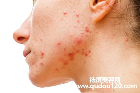 面部痤疮用什么药膏最好（痤疮外涂什么药膏比较好）