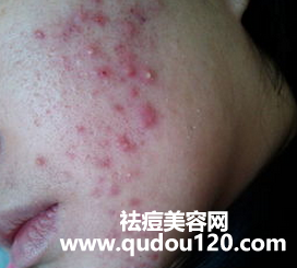 面部痤疮用什么药膏最好（痤疮外涂什么药膏比较好）
