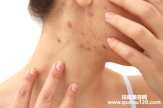 痤疮皮肤形成的原因（皮肤痤疮是怎么形成的）