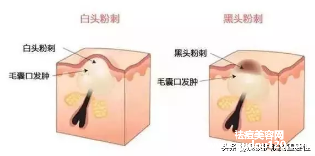 封闭性粉刺用什么药膏最有效（去闭口粉刺最有效的方法）