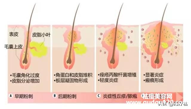 喝牛奶的危害竟然是长痘（为什么喝牛奶容易长痘）