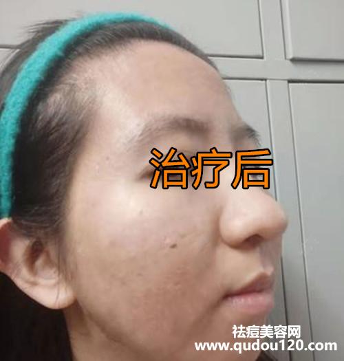激光祛除痘印多长时间能恢复（激光祛痘印能彻底去掉吗）