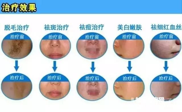 激光祛痘一般疗程多久（祛痘需要几个疗程）