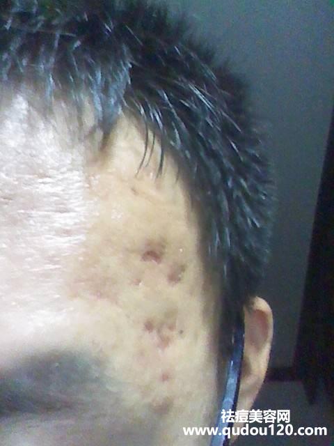 激光祛痘印多久见效（激光祛痘坑痘印多长时间能好）