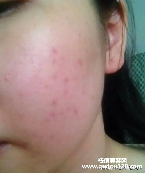 皮肤角质层变薄怎么办（脸皮肤角质层薄怎么改善）